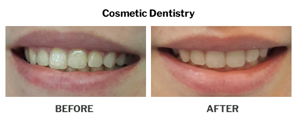 Cosmetic Dentistry Before And After Results