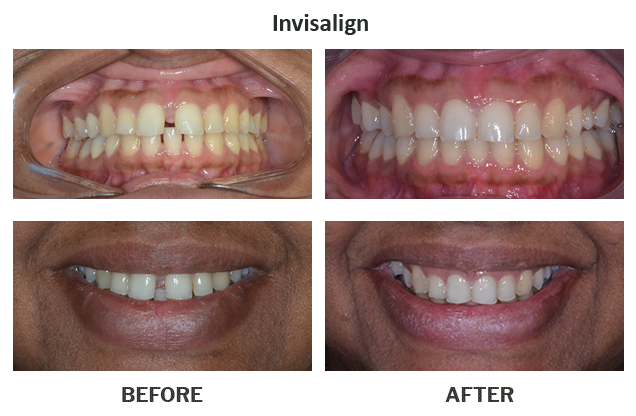 Treatment by Dr. Punit Thawani using Invisalign - Before And After Results