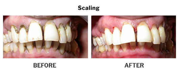 Treatment by Dr. Punit Thawani using Periodontics - Before And After Results