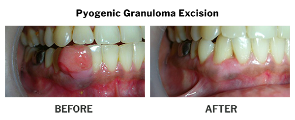 Treatment by Dr. Punit Thawani using Periodontics - Before And After Results