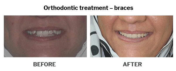 Orthodontic treatment braces case 04