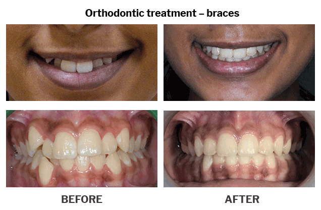 Orthodontic treatment braces case 07