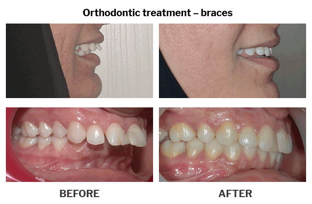 Orthodontic treatment braces case 08
