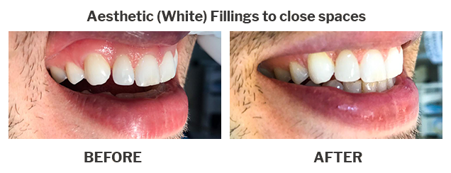Aesthetic white fillings Case 03